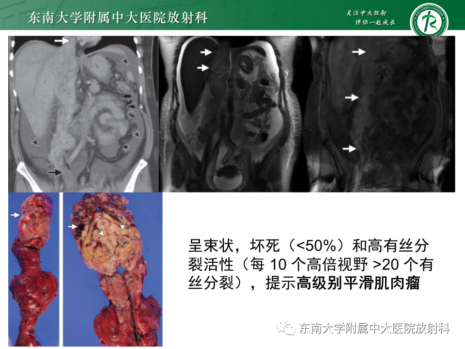影像PPT - 【PPT】下腔静脉栓塞性病变随访-19 影像PPT - 【PPT】下腔静脉栓塞性病变随访-19