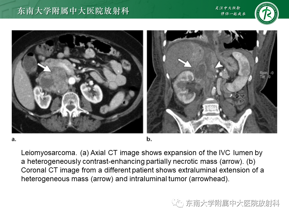 影像PPT - 【PPT】下腔静脉栓塞性病变随访-16 影像PPT - 【PPT】下腔静脉栓塞性病变随访-16