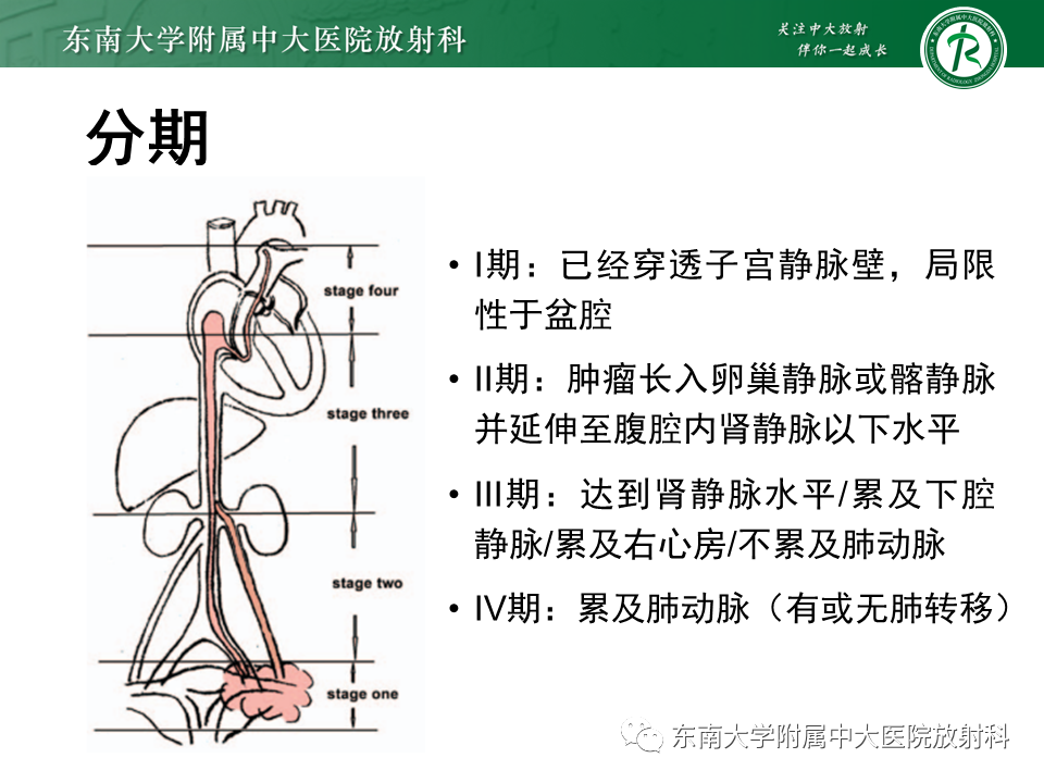 影像PPT - 【PPT】下腔静脉栓塞性病变随访-22 影像PPT - 【PPT】下腔静脉栓塞性病变随访-22