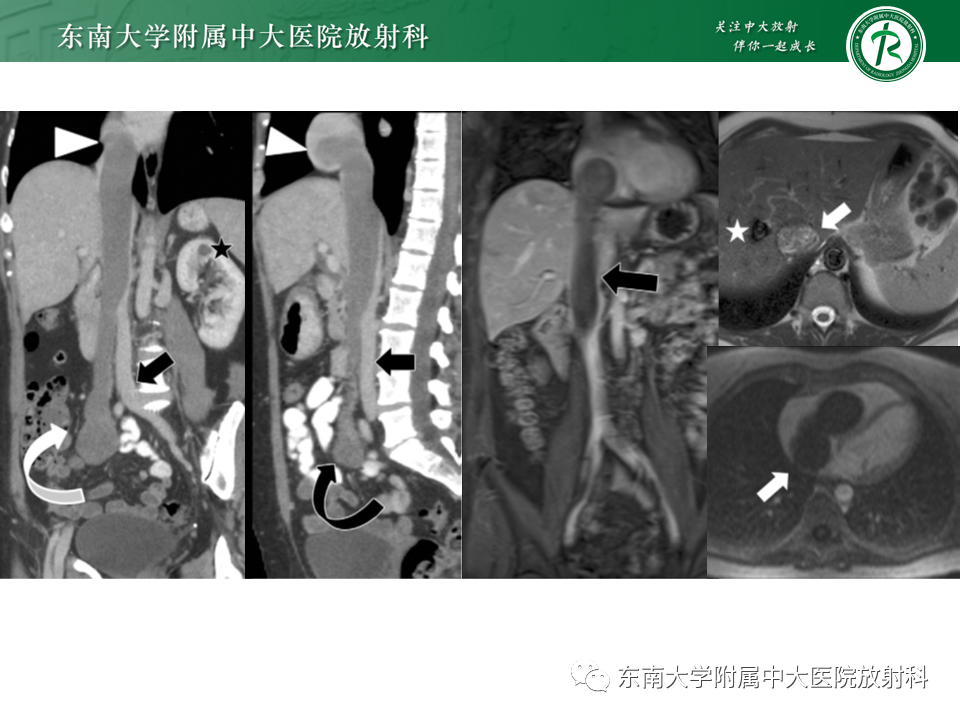 影像PPT - 【PPT】下腔静脉栓塞性病变随访-24 影像PPT - 【PPT】下腔静脉栓塞性病变随访-24