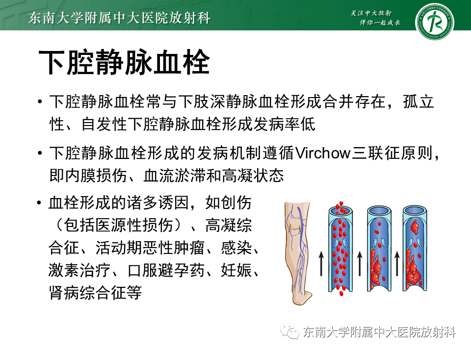 影像PPT - 【PPT】下腔静脉栓塞性病变随访-25 影像PPT - 【PPT】下腔静脉栓塞性病变随访-25