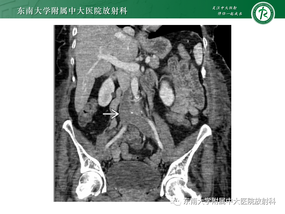 影像PPT - 【PPT】下腔静脉栓塞性病变随访-27 影像PPT - 【PPT】下腔静脉栓塞性病变随访-27