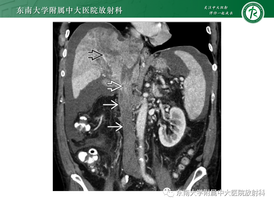 影像PPT - 【PPT】下腔静脉栓塞性病变随访-29 影像PPT - 【PPT】下腔静脉栓塞性病变随访-29