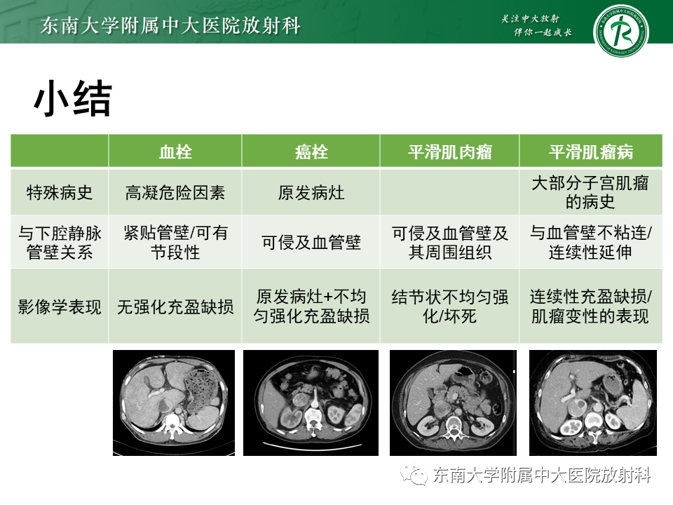 影像PPT - 【PPT】下腔静脉栓塞性病变随访-30 影像PPT - 【PPT】下腔静脉栓塞性病变随访-30