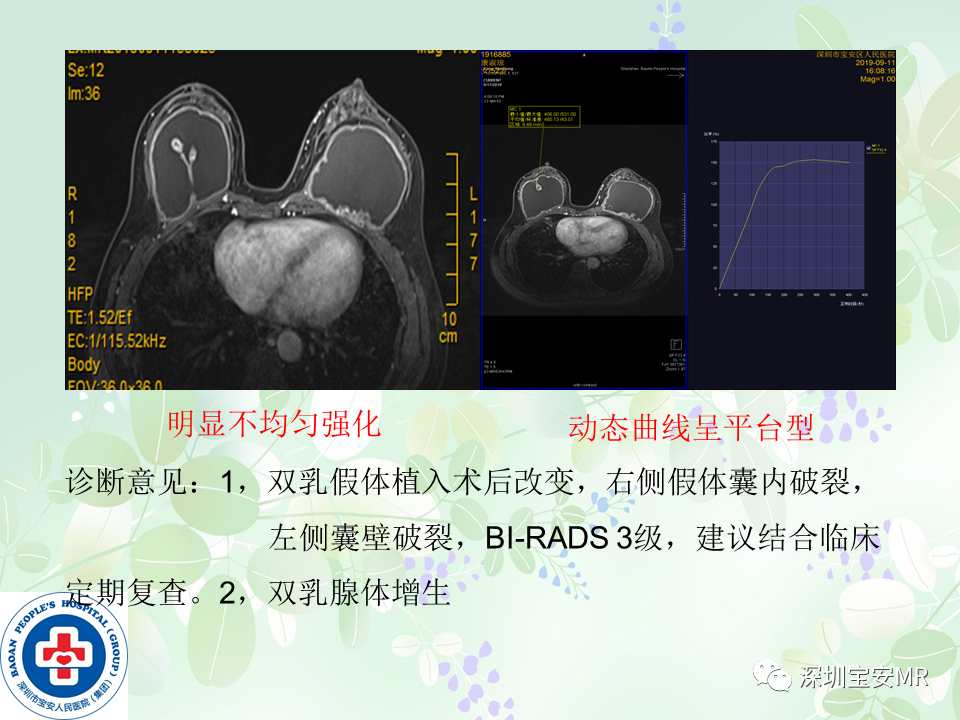 影像PPT - 【PPT】乳腺磁共振扫描-23