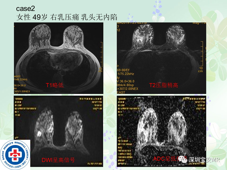 影像PPT - 【PPT】乳腺磁共振扫描-24