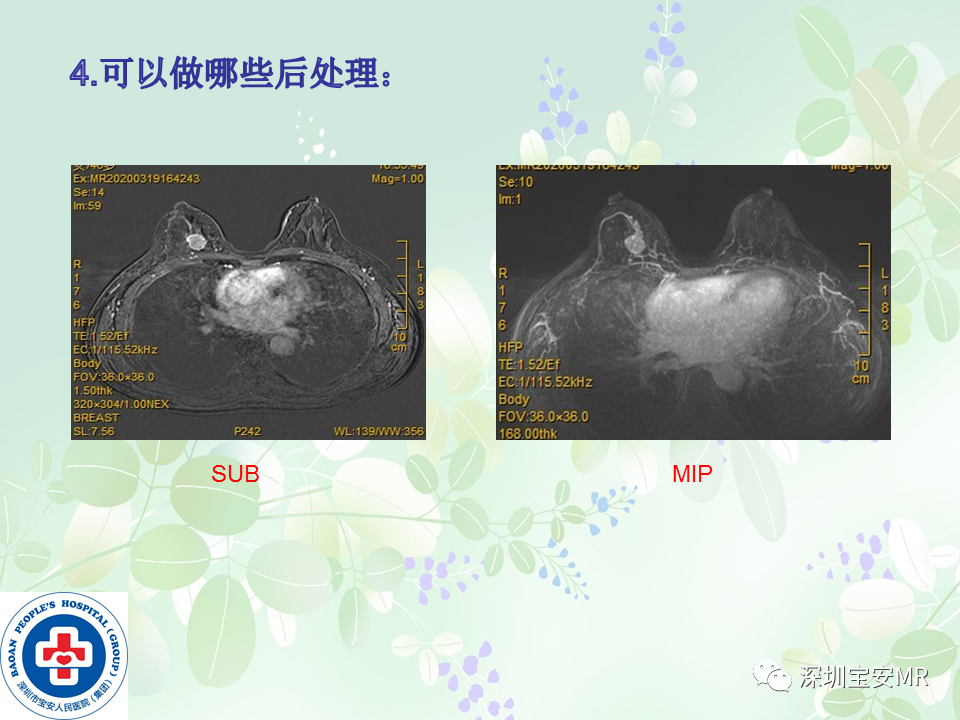 影像PPT - 【PPT】乳腺磁共振扫描-20