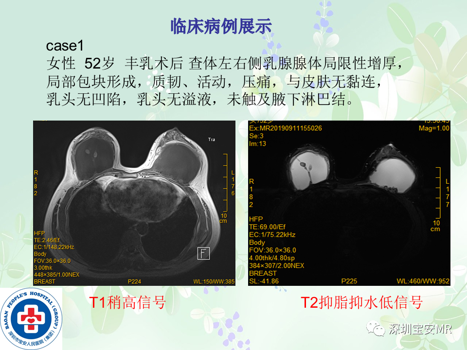 影像PPT - 【PPT】乳腺磁共振扫描-22
