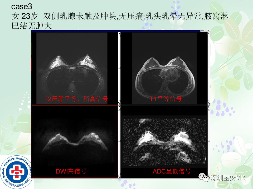 影像PPT - 【PPT】乳腺磁共振扫描-27