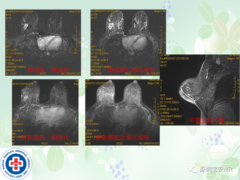 影像PPT - 【PPT】乳腺磁共振扫描-25