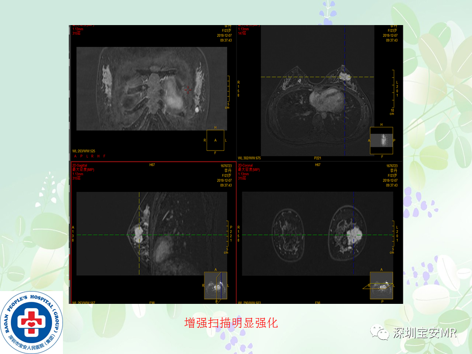 影像PPT - 【PPT】乳腺磁共振扫描-28