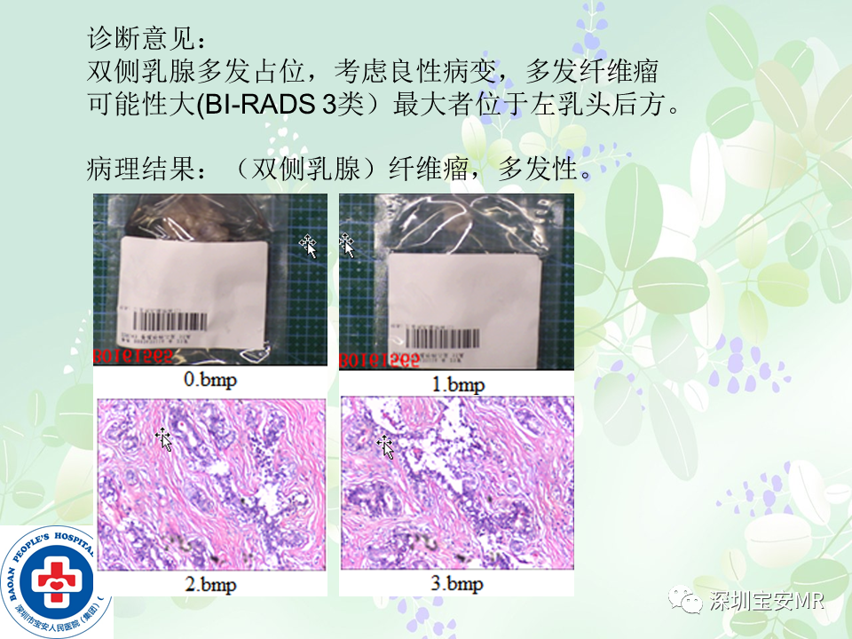 影像PPT - 【PPT】乳腺磁共振扫描-29