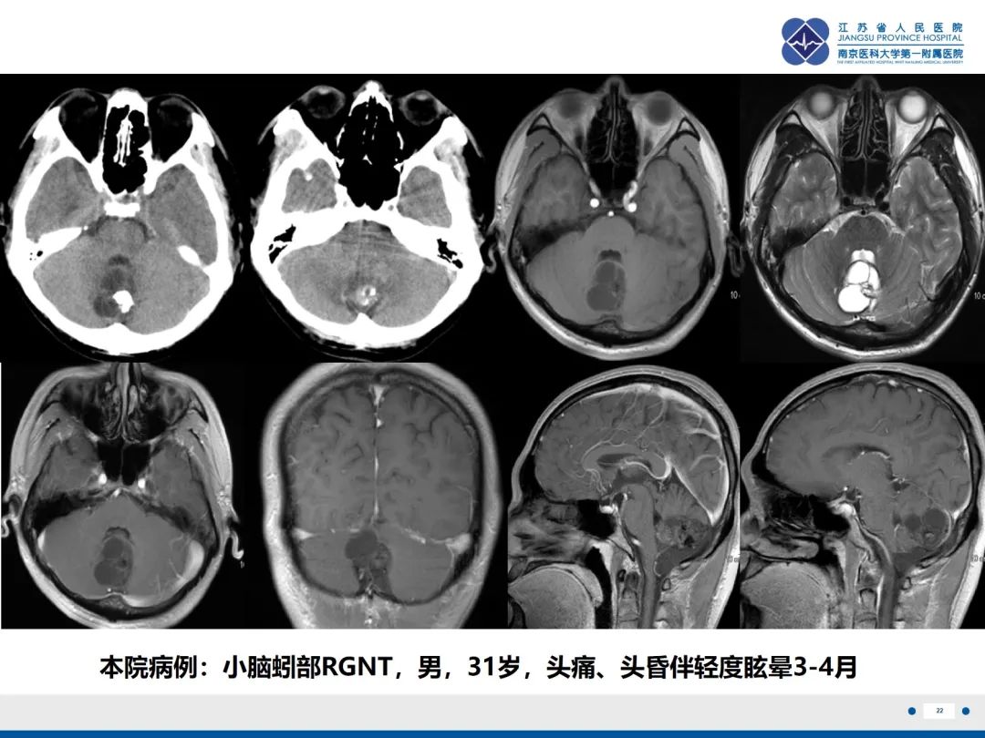 影像PPT - 【PPT】菊形团形成型胶质神经元肿瘤-23