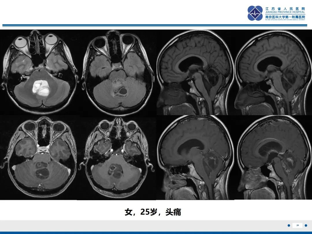 影像PPT - 【PPT】菊形团形成型胶质神经元肿瘤-25