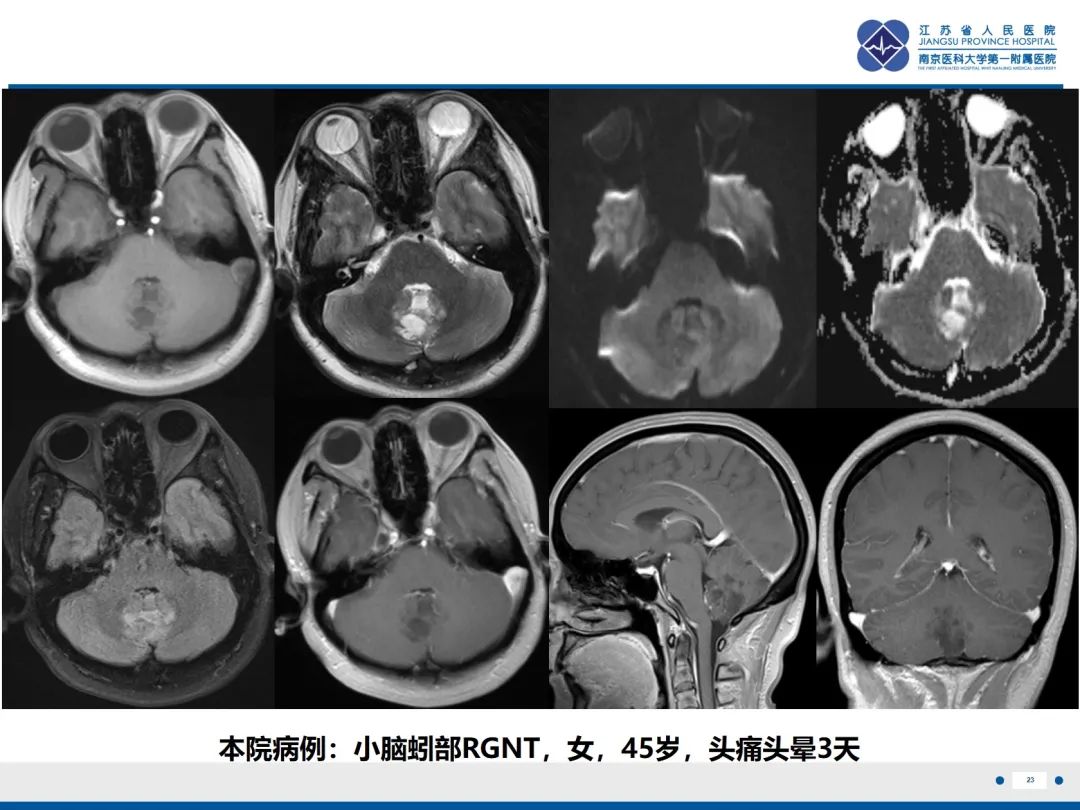 影像PPT - 【PPT】菊形团形成型胶质神经元肿瘤-24