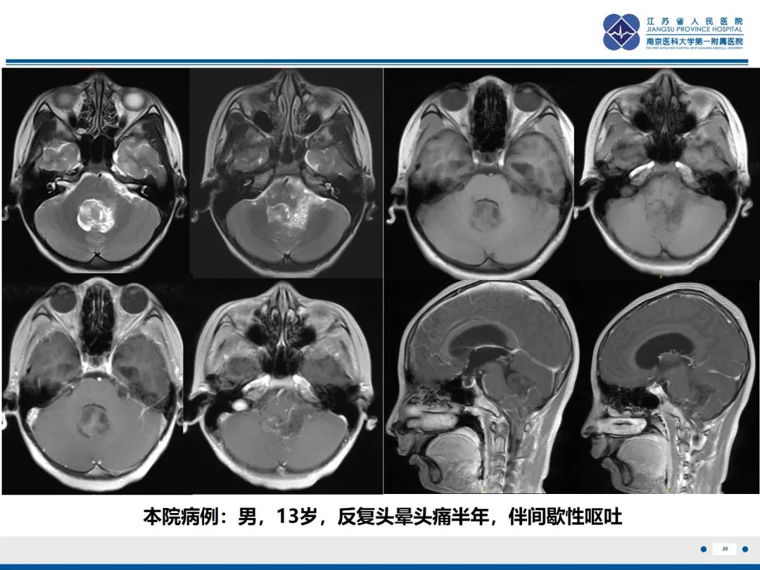 影像PPT - 【PPT】菊形团形成型胶质神经元肿瘤-30