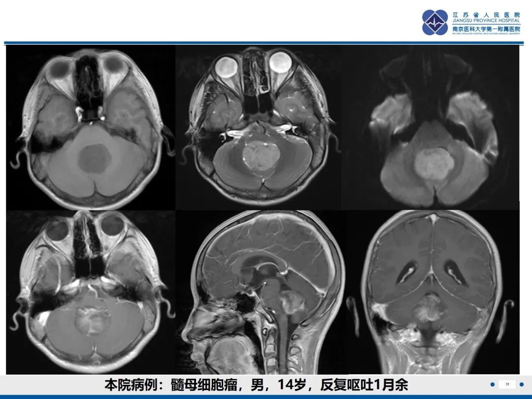 影像PPT - 【PPT】菊形团形成型胶质神经元肿瘤-32