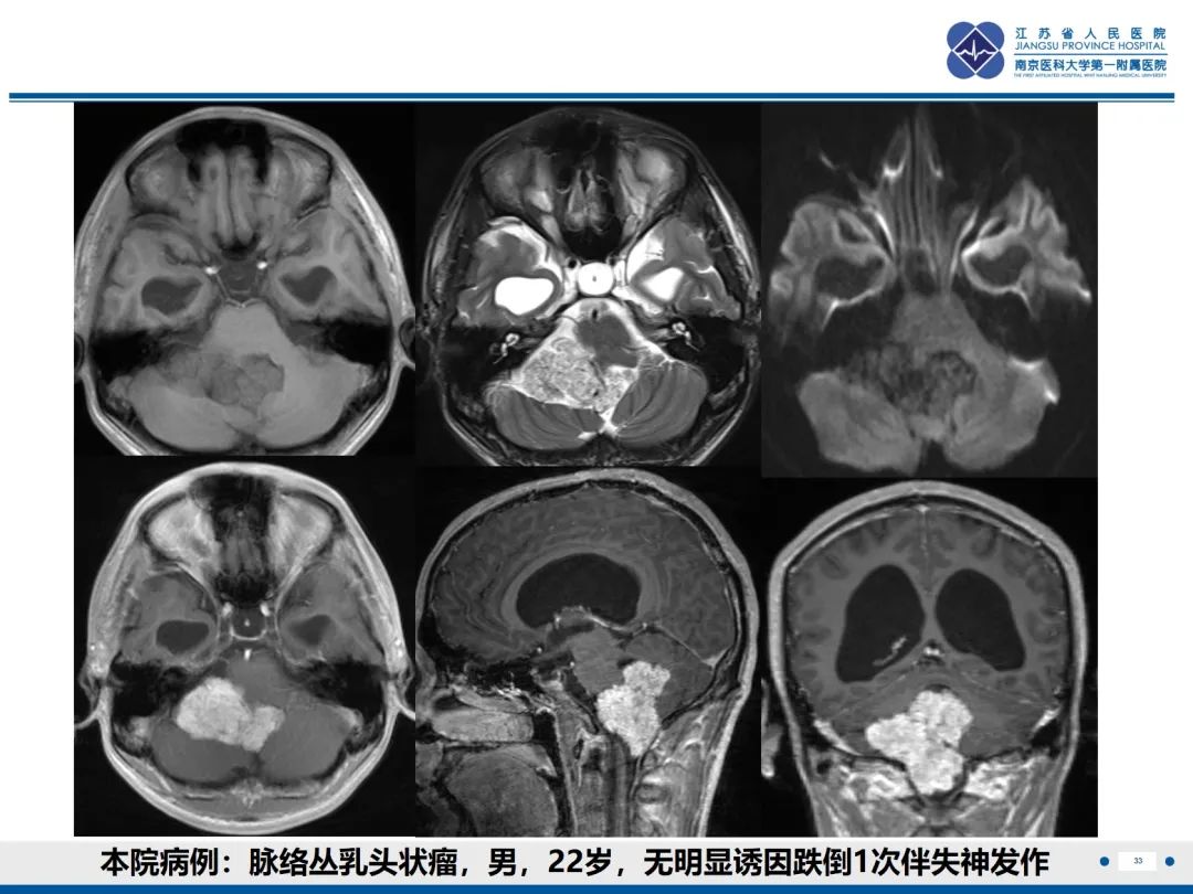 影像PPT - 【PPT】菊形团形成型胶质神经元肿瘤-34