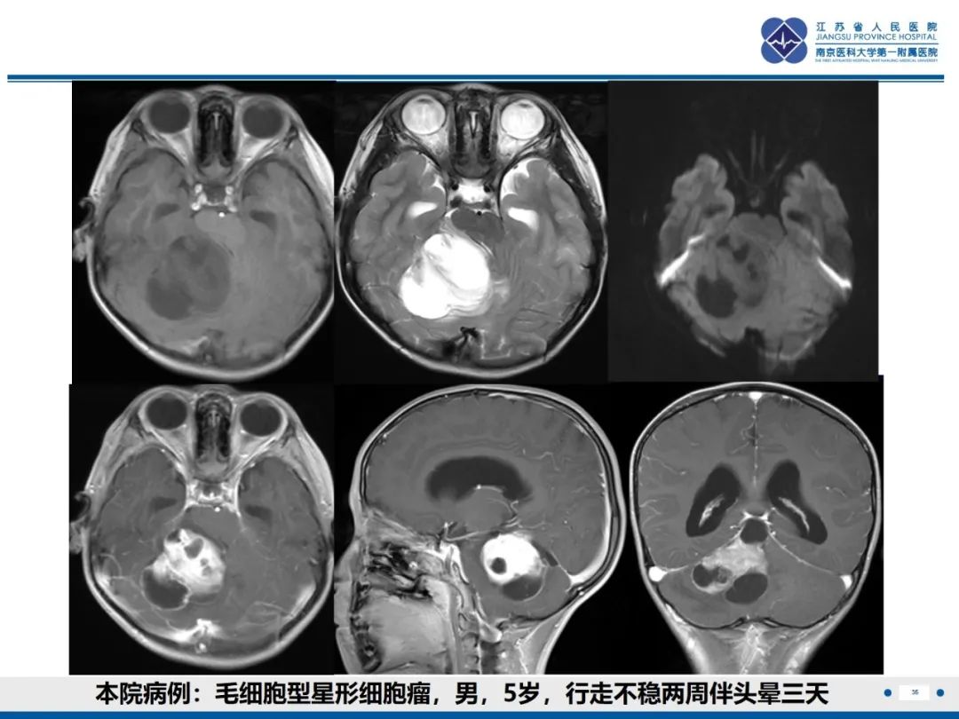 影像PPT - 【PPT】菊形团形成型胶质神经元肿瘤-36