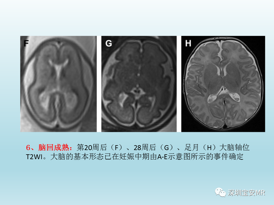 影像PPT - 【PPT】幕上脑畸形MRI表现-6