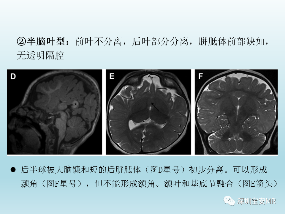 影像PPT - 【PPT】幕上脑畸形MRI表现-10