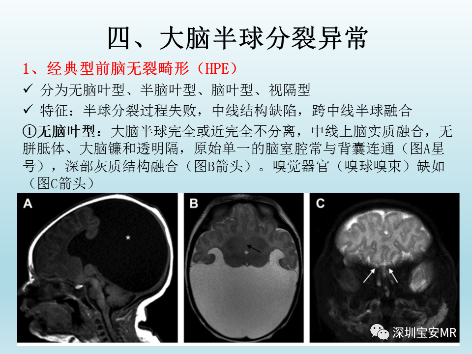 影像PPT - 【PPT】幕上脑畸形MRI表现-9
