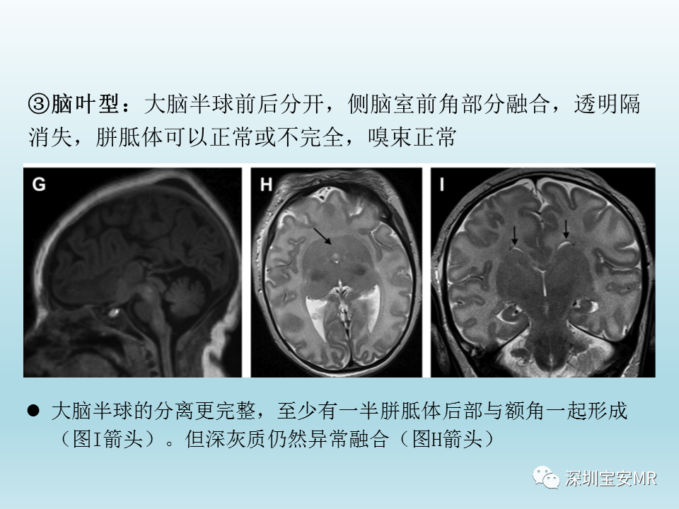 影像PPT - 【PPT】幕上脑畸形MRI表现-11