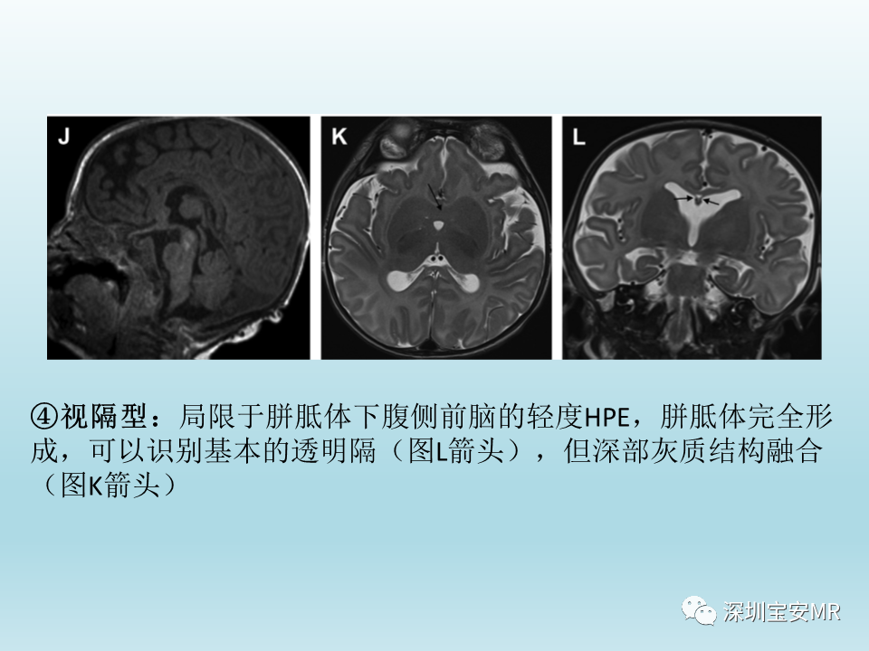 影像PPT - 【PPT】幕上脑畸形MRI表现-12