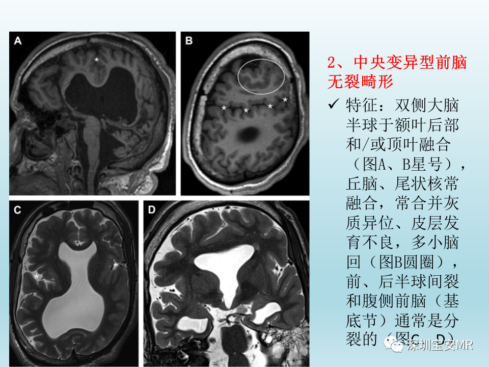 影像PPT - 【PPT】幕上脑畸形MRI表现-13