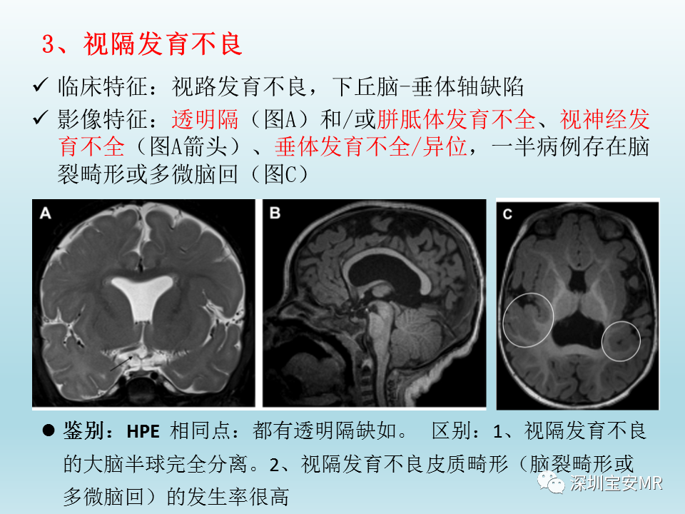 影像PPT - 【PPT】幕上脑畸形MRI表现-14