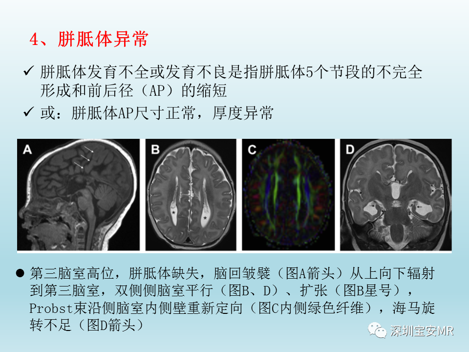 影像PPT - 【PPT】幕上脑畸形MRI表现-15