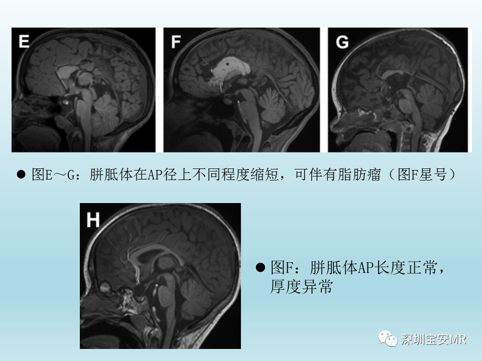 影像PPT - 【PPT】幕上脑畸形MRI表现-16
