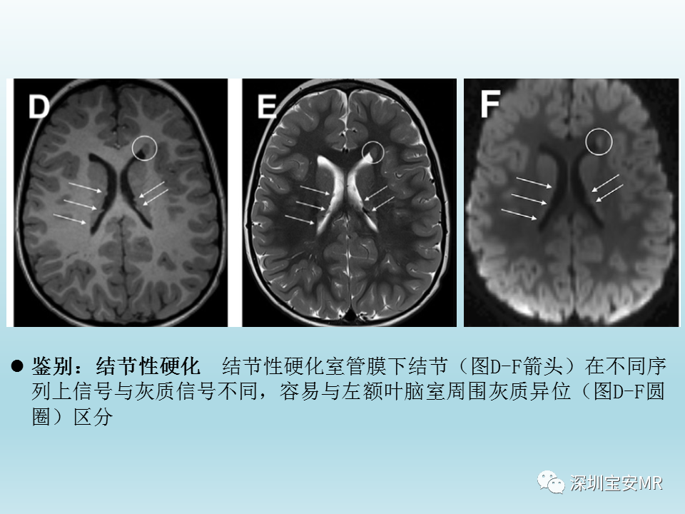 影像PPT - 【PPT】幕上脑畸形MRI表现-18