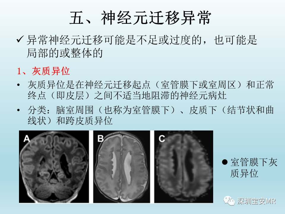 影像PPT - 【PPT】幕上脑畸形MRI表现-17