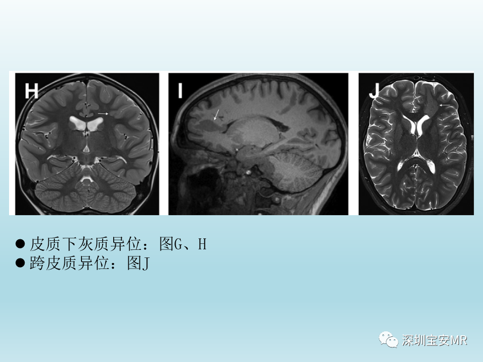 影像PPT - 【PPT】幕上脑畸形MRI表现-19
