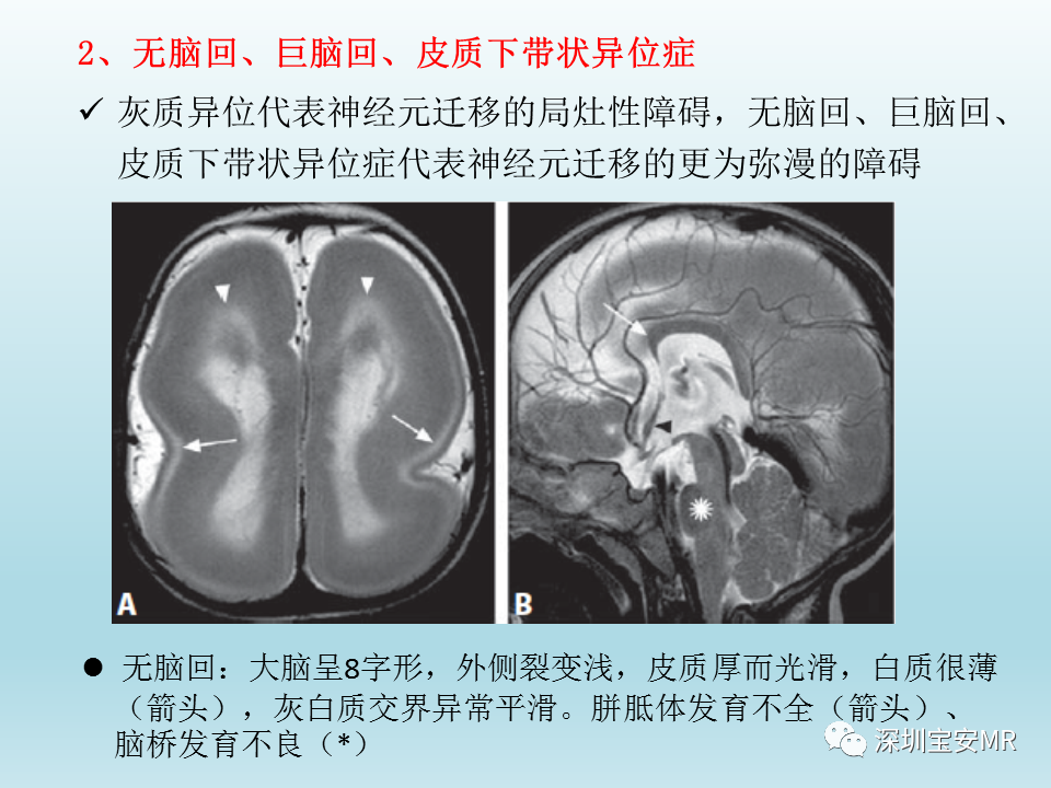 影像PPT - 【PPT】幕上脑畸形MRI表现-20