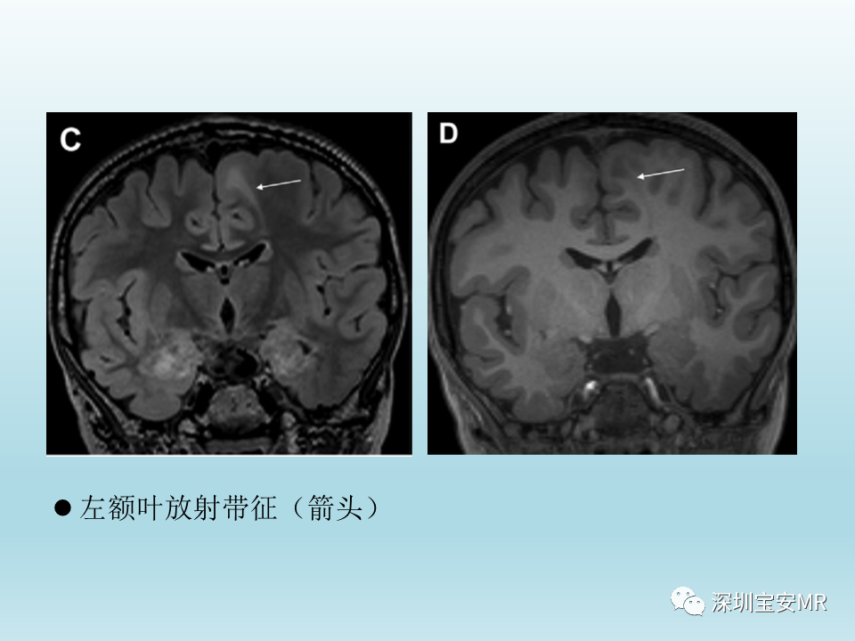 影像PPT - 【PPT】幕上脑畸形MRI表现-24
