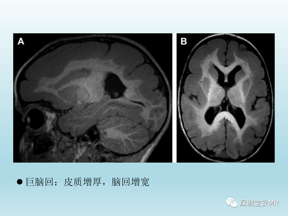 影像PPT - 【PPT】幕上脑畸形MRI表现-21