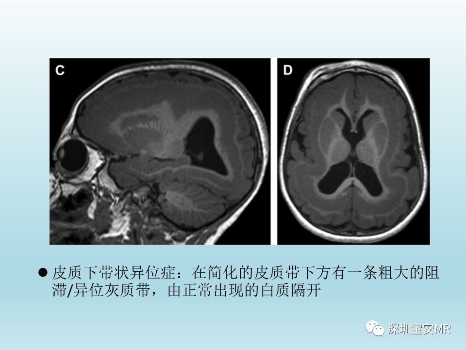 影像PPT - 【PPT】幕上脑畸形MRI表现-22