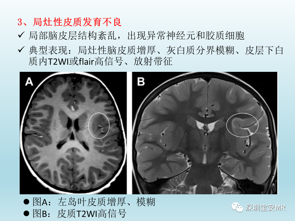 影像PPT - 【PPT】幕上脑畸形MRI表现-23