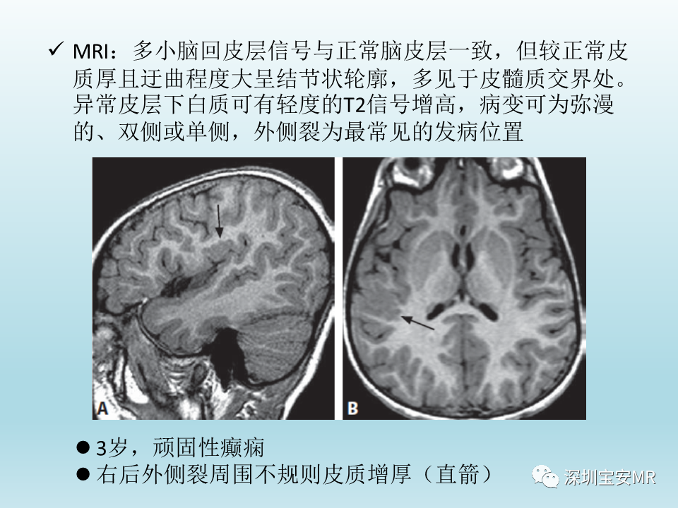 影像PPT - 【PPT】幕上脑畸形MRI表现-27