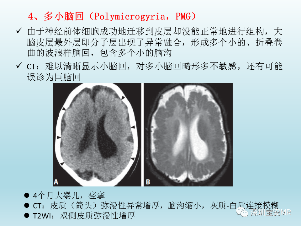 影像PPT - 【PPT】幕上脑畸形MRI表现-26