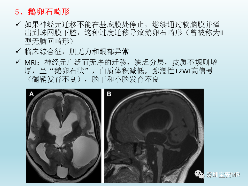 影像PPT - 【PPT】幕上脑畸形MRI表现-29