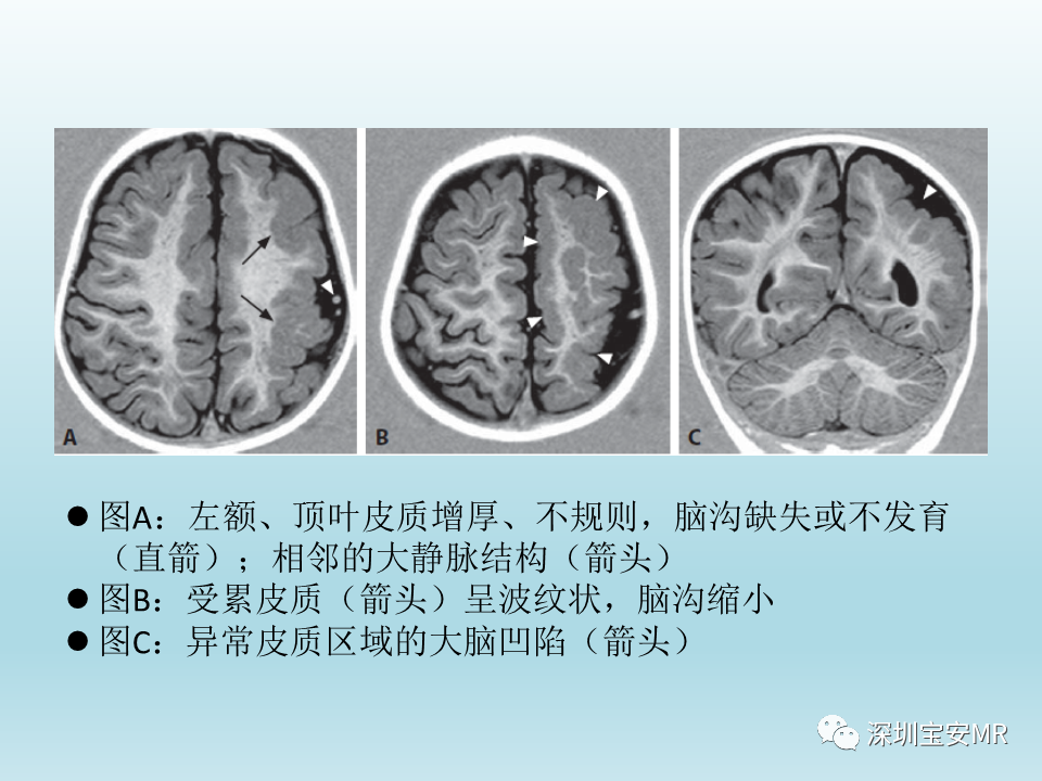 影像PPT - 【PPT】幕上脑畸形MRI表现-28