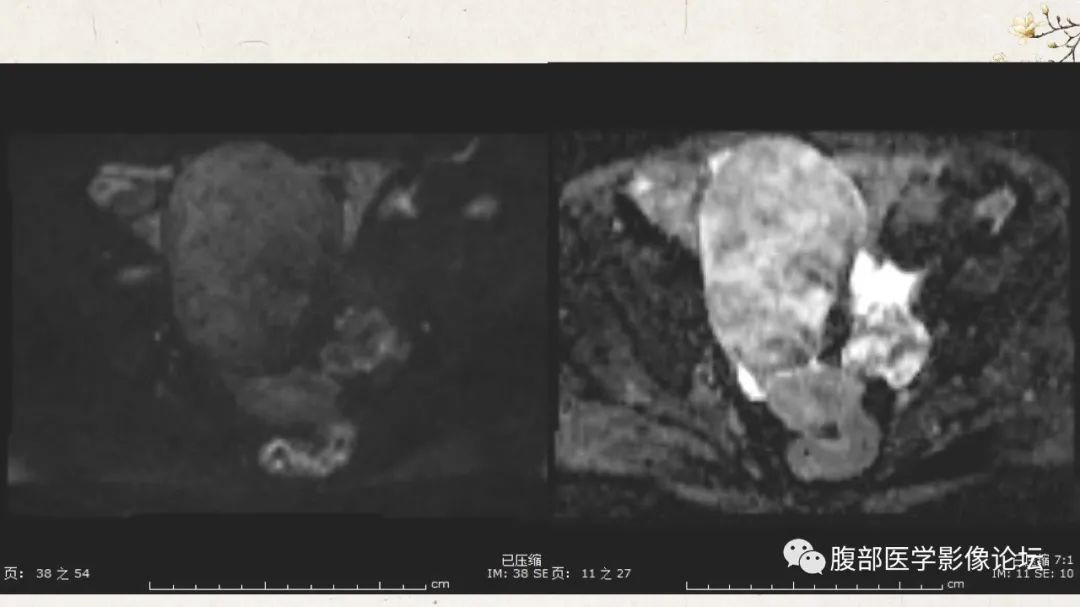 影像PPT - 【病例】卵巢纤维瘤 VS 子宫阔韧带肌瘤-9