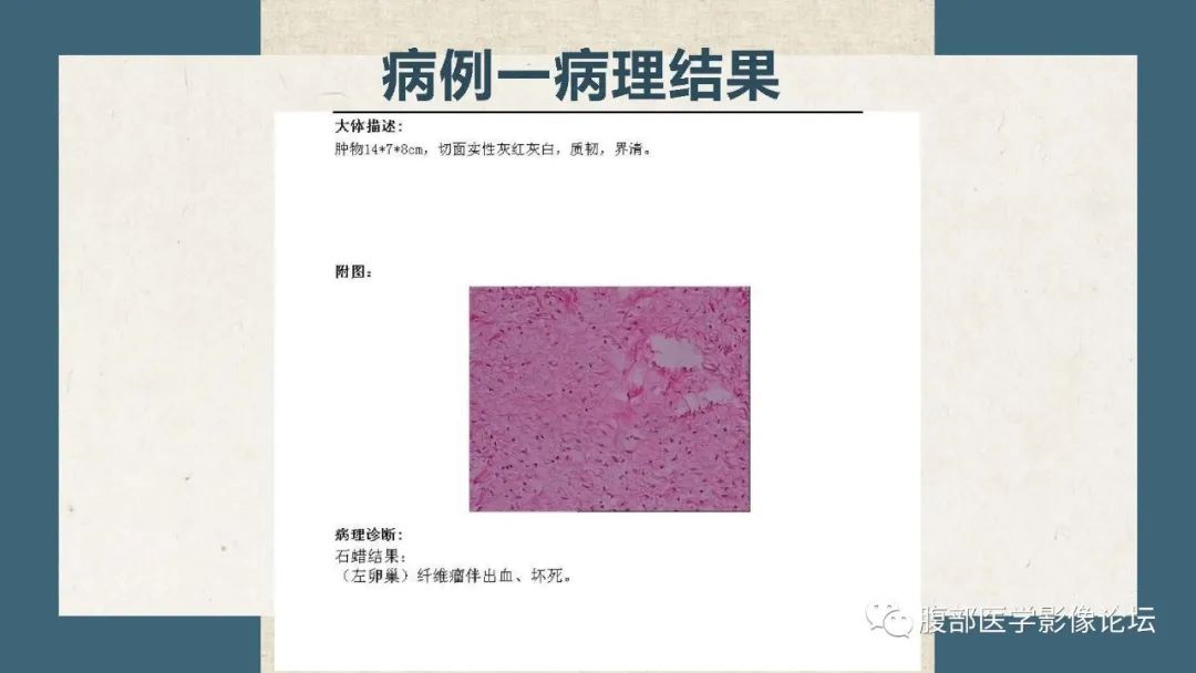 影像PPT - 【病例】卵巢纤维瘤 VS 子宫阔韧带肌瘤-12