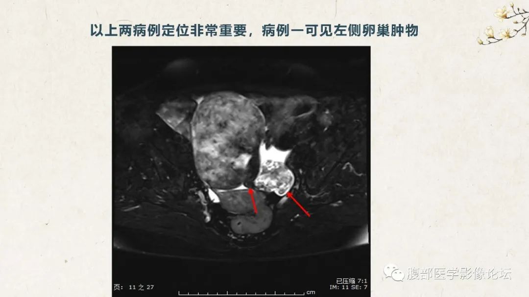 影像PPT - 【病例】卵巢纤维瘤 VS 子宫阔韧带肌瘤-13