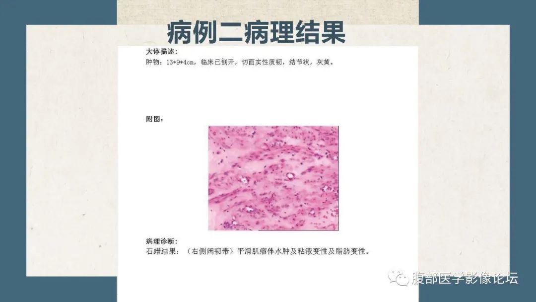 影像PPT - 【病例】卵巢纤维瘤 VS 子宫阔韧带肌瘤-26