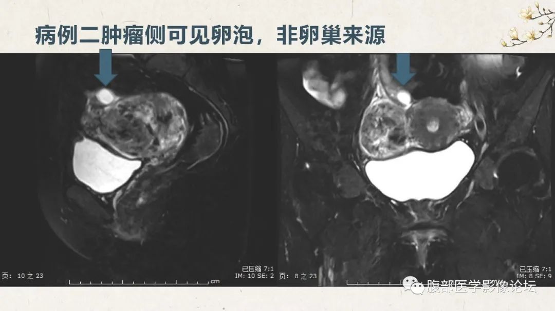 影像PPT - 【病例】卵巢纤维瘤 VS 子宫阔韧带肌瘤-27