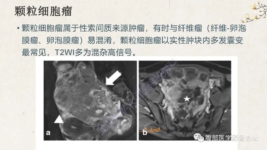 影像PPT - 【病例】卵巢纤维瘤 VS 子宫阔韧带肌瘤-44